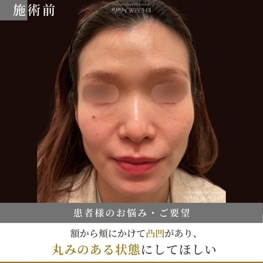 ヒアルロン酸 施術前