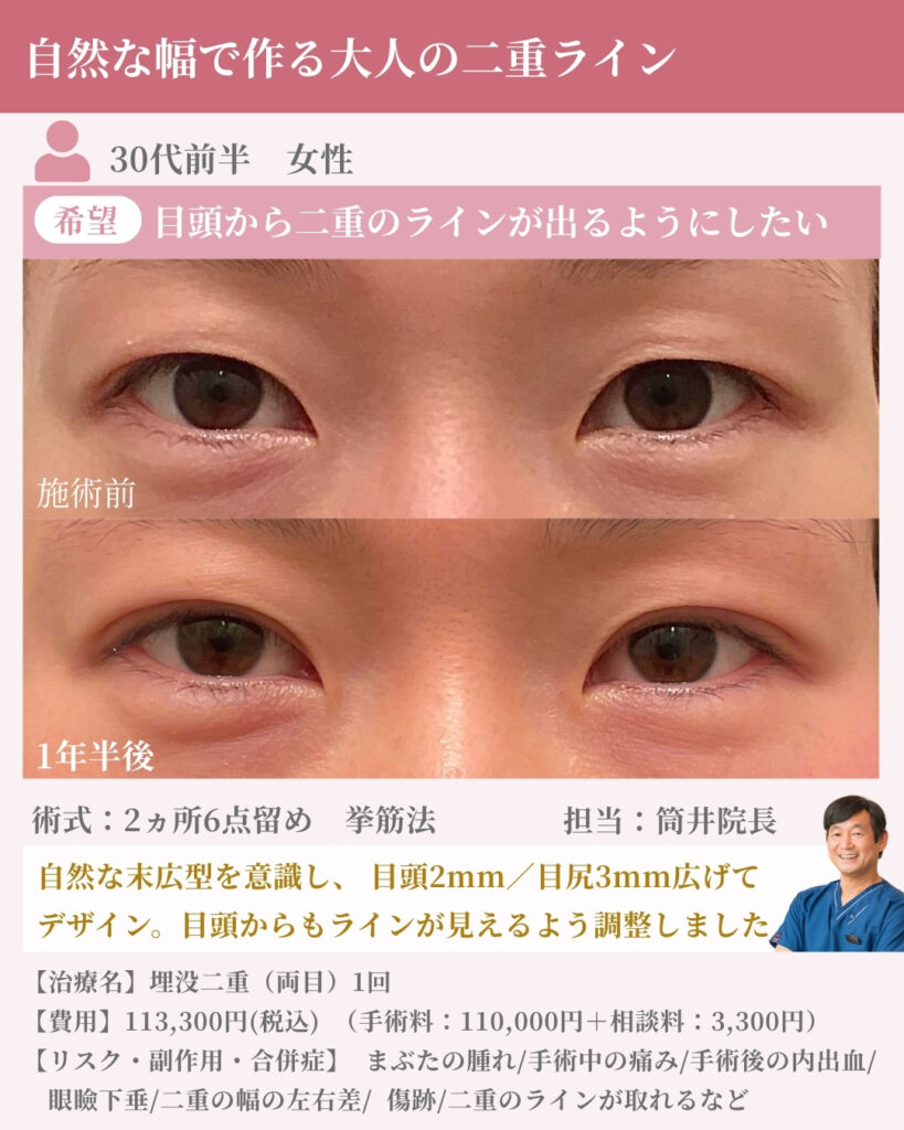 自然な幅で作る大人の二重ライン