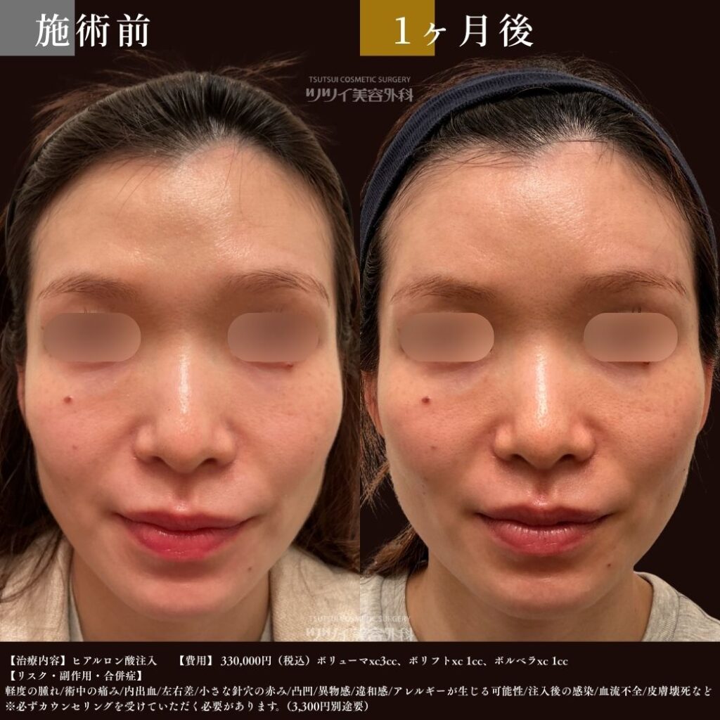 ヒアルロン酸 症例