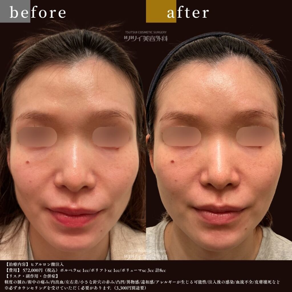 ヒアルロン酸 before after
