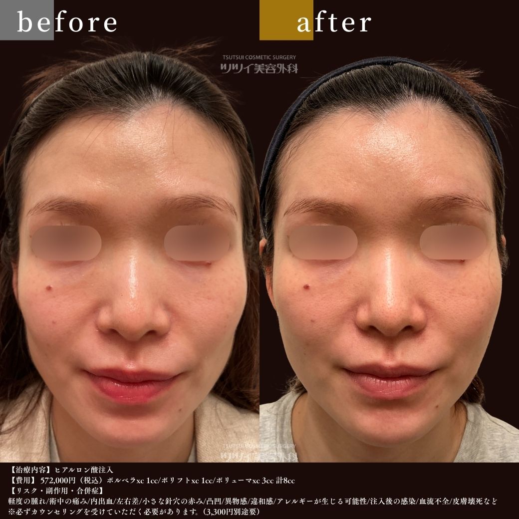 ヒアルロン酸 before after