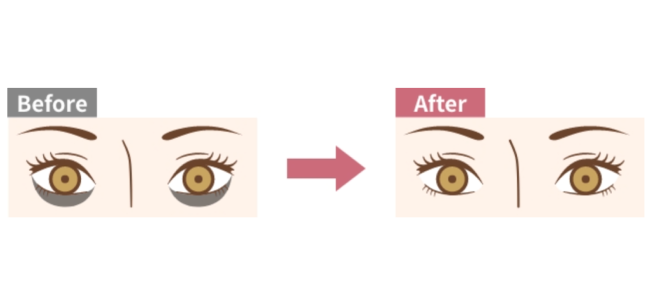 ヒアルロン酸注入(目の下のクマ)