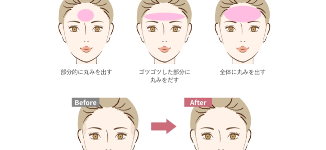 ヒアルロン酸注入(額・おでこ)