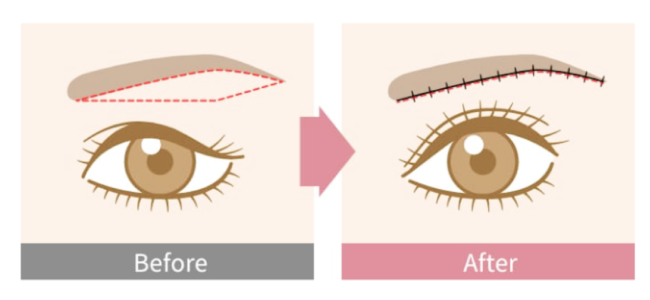 眉下リフト（眉下切開）
