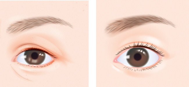 目の下の脂肪・たるみ取り