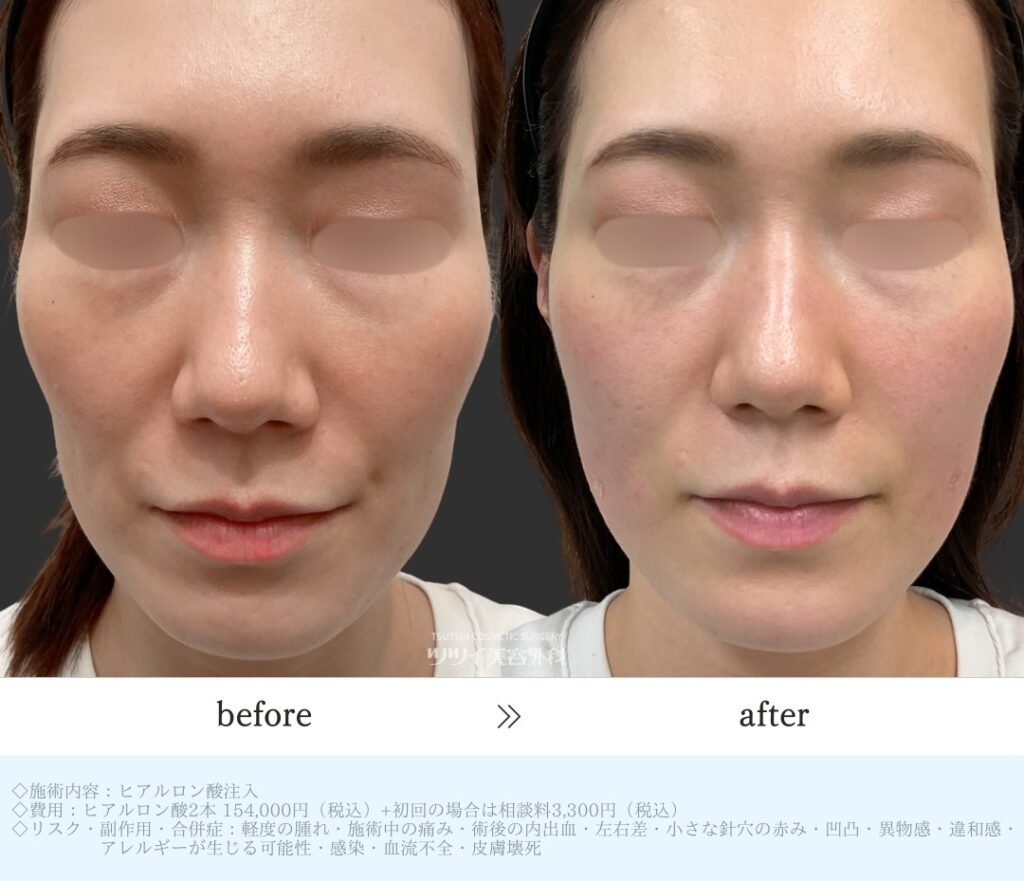 ヒアルロン酸　ほうれい線・頬コケ症例