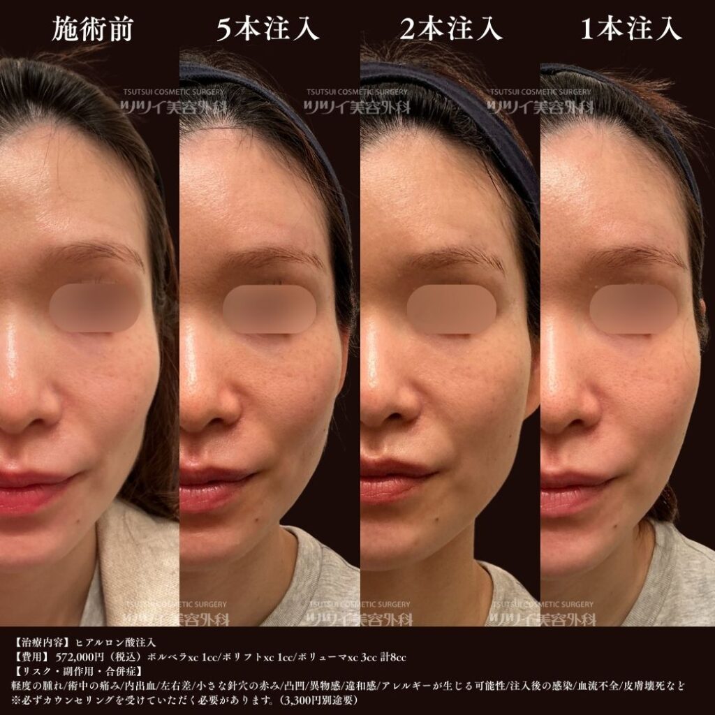 ヒアルロン酸 症例