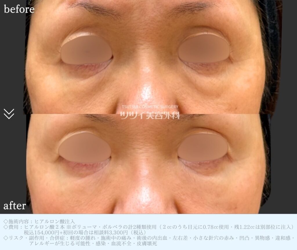 ヒアルロン酸注入　目の下クマ症・たるみ症例