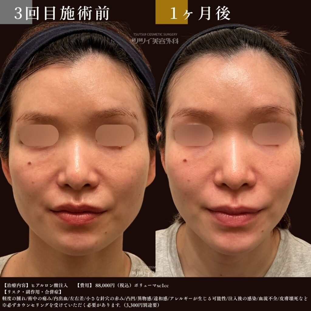 ヒアルロン酸 症例