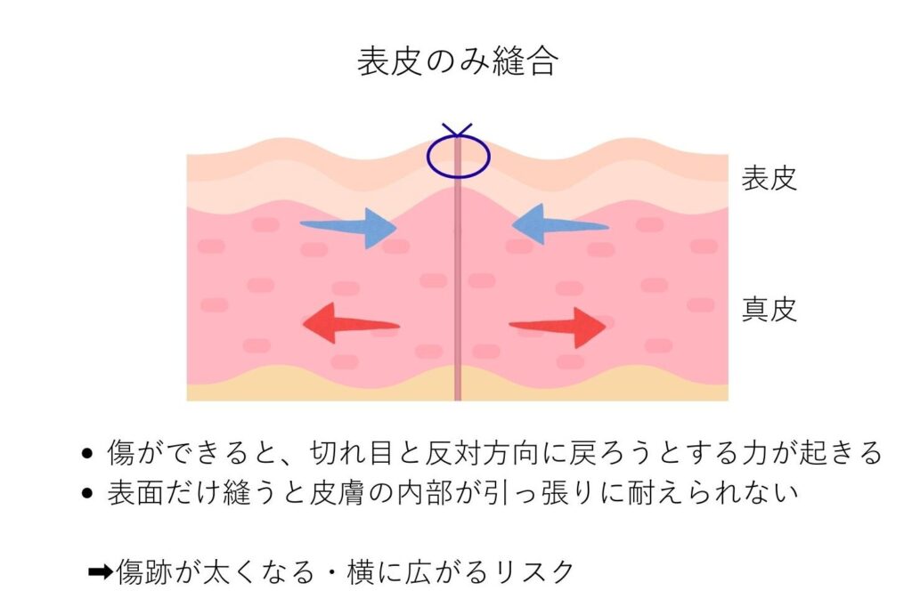 小陰唇縮小術　表皮縫合　図解説明
