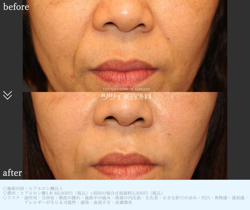 ヒアルロン酸注入　ほうれい線症例画像