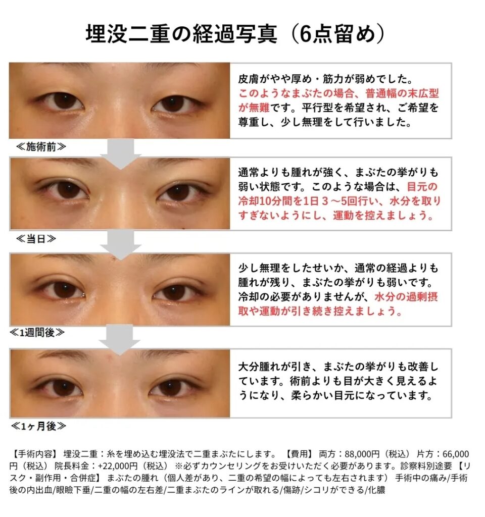 埋没二重　経過写真