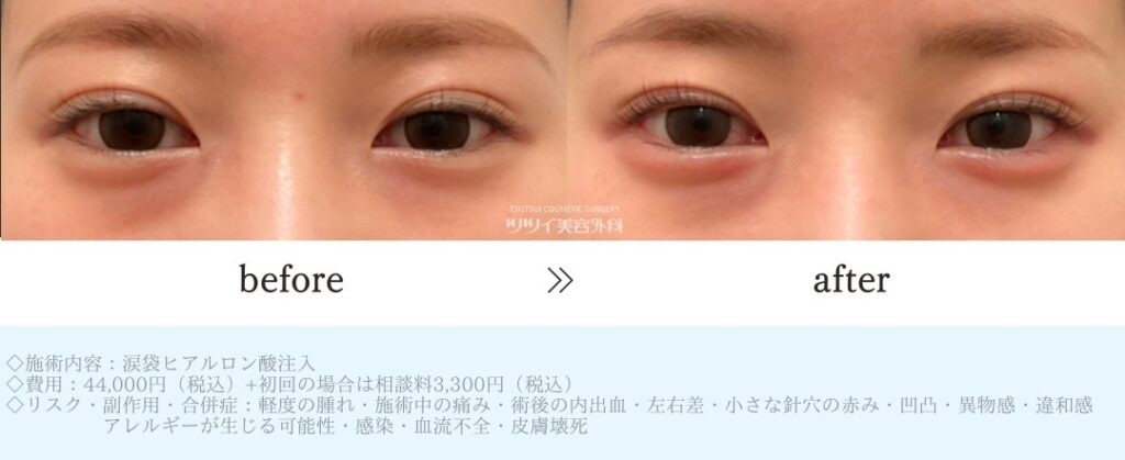 ヒアルロン酸 涙袋症例