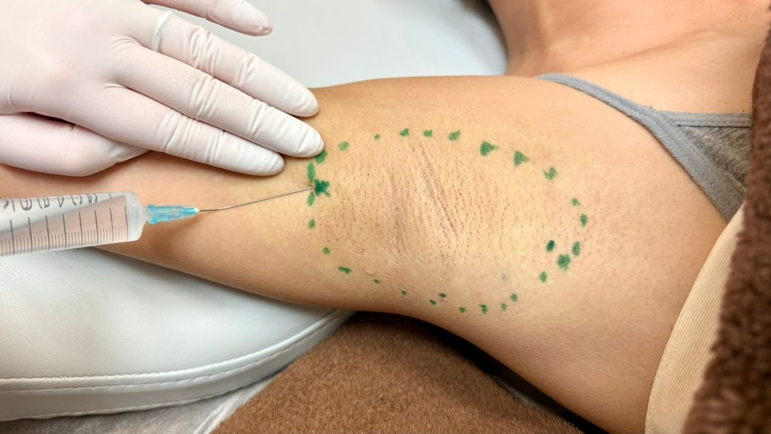 【施術当日 】麻酔