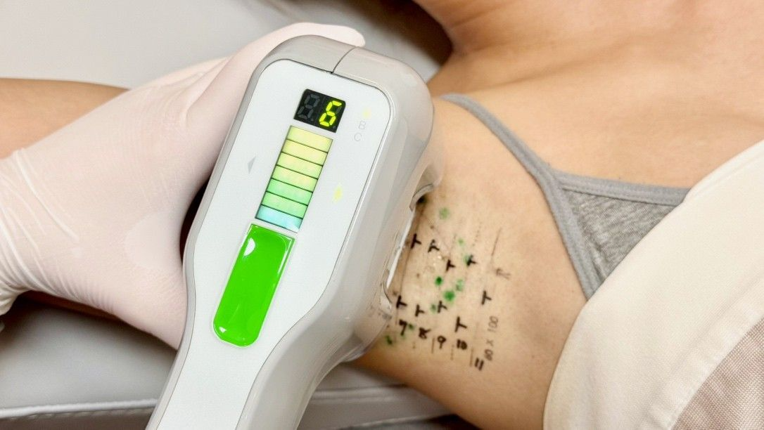 ミラドライ照射