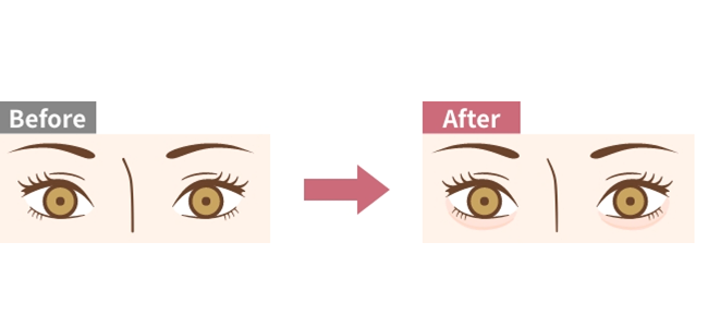 ヒアルロン酸注入(涙袋)