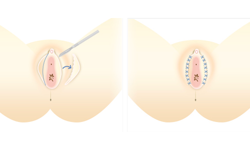 小陰唇縮小術 (クリトリス包茎/副皮切除術／連結部分切除術)