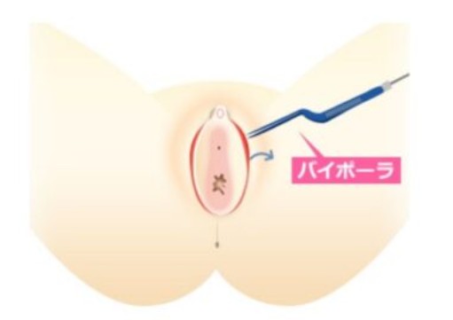 【手術日】止血