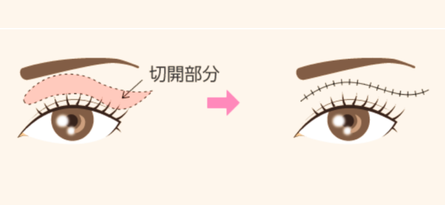 目の上の脂肪・たるみ取り