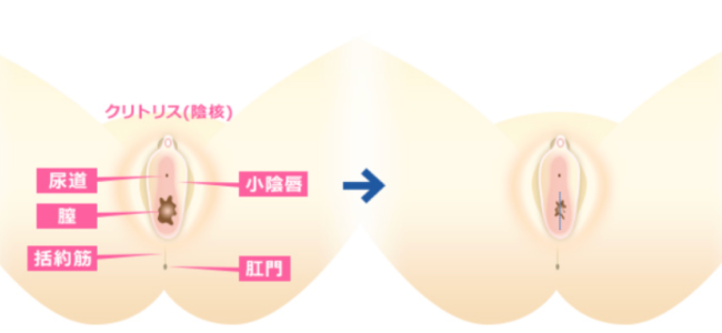 膣縮小術