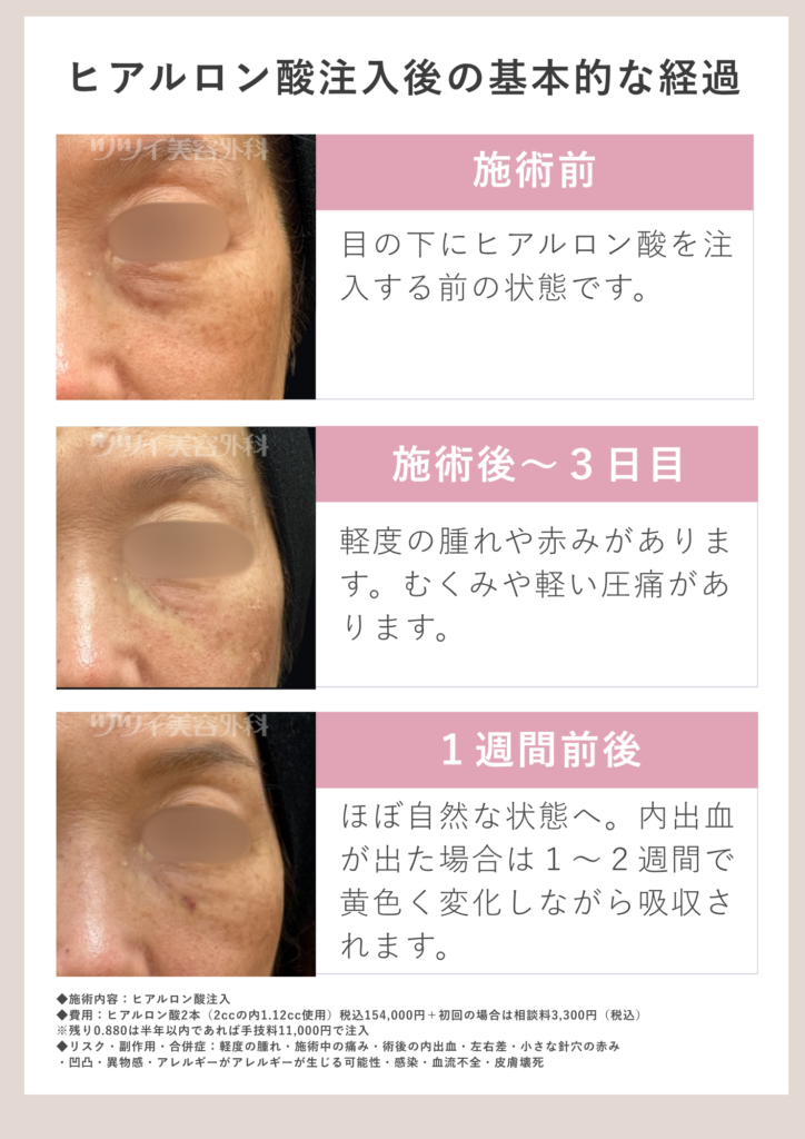 ヒアルロン酸注入後の基本的な経過