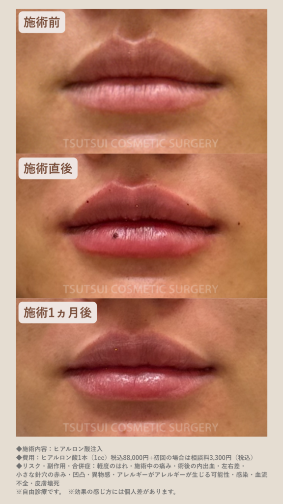 症例ヒアルロン酸　唇　経過写真