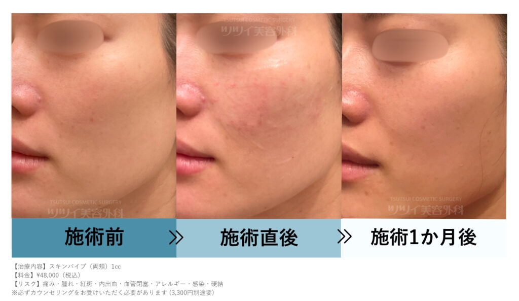 スキンバイブ30代・両頬に計1㏄注入した症例
