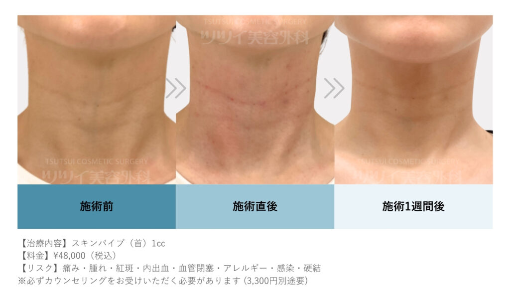 スキンバイブ30代・首に計1㏄注入した症例