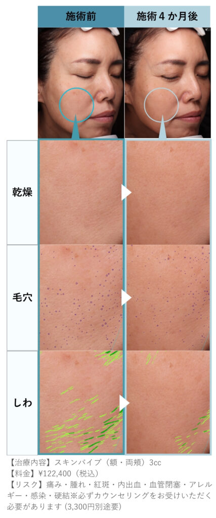スキンバイブ60代・頬と額に計3㏄注入した症例
