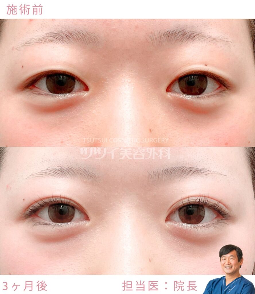 埋没法による二重整形の症例（施術前と施術後の比較・両目）