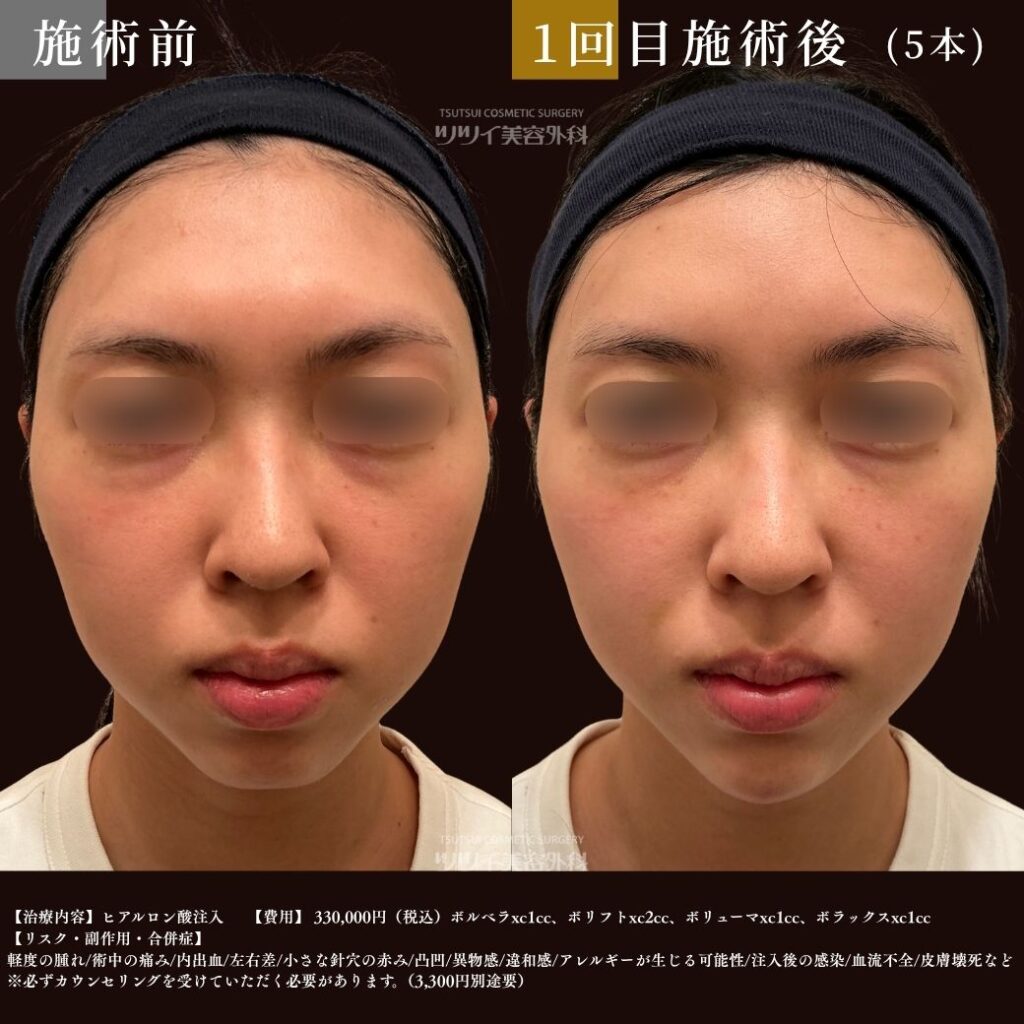 1回目　症例写真（ヒアルロン酸5本）