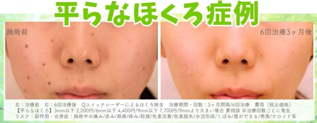 症例写真　平らなほくろ