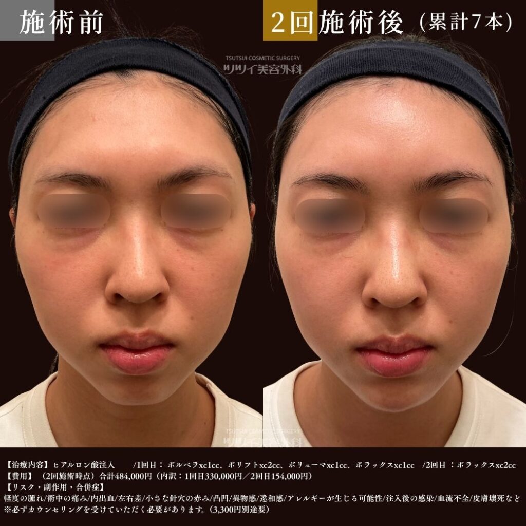2回目　症例写真（ヒアルロン酸累計7本）