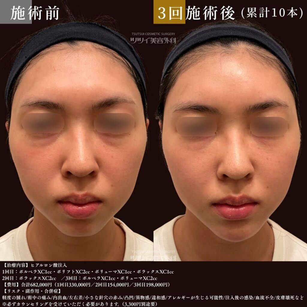 3回目　症例写真（ヒアルロン酸累計10本）