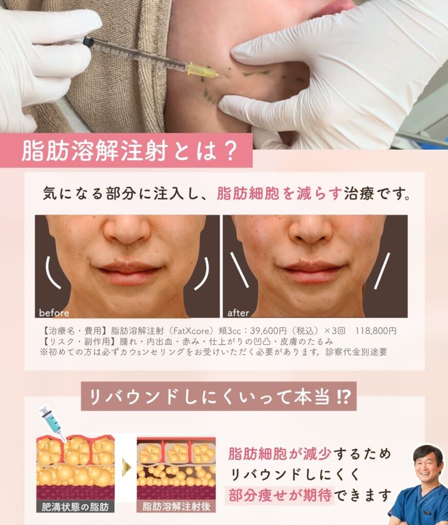 脂肪溶解注射とは