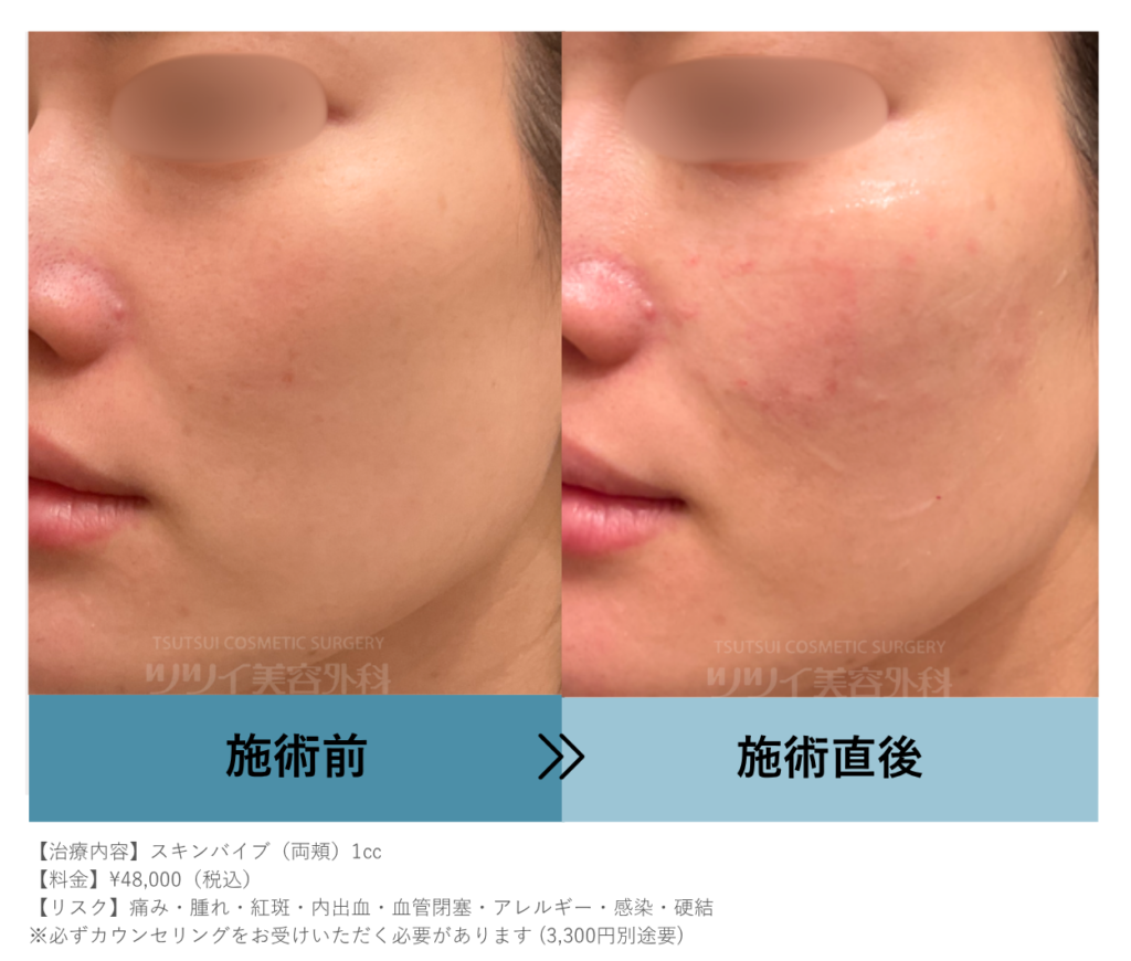 30代女性スキンバイブ注入直後の症例画像