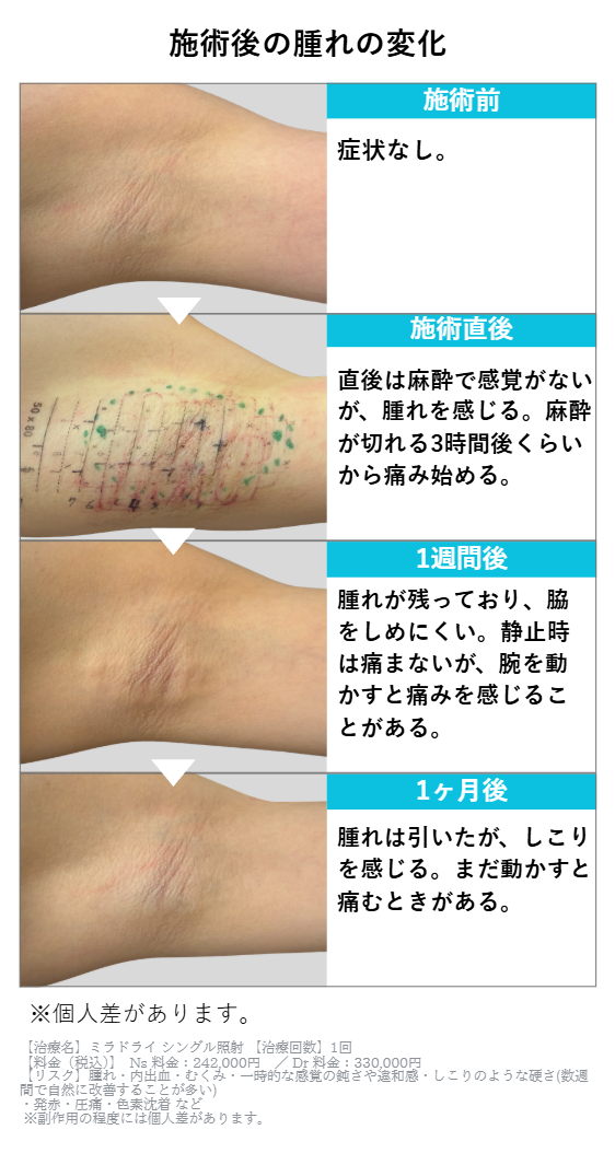 ミラドライ施術後の腫れの変化