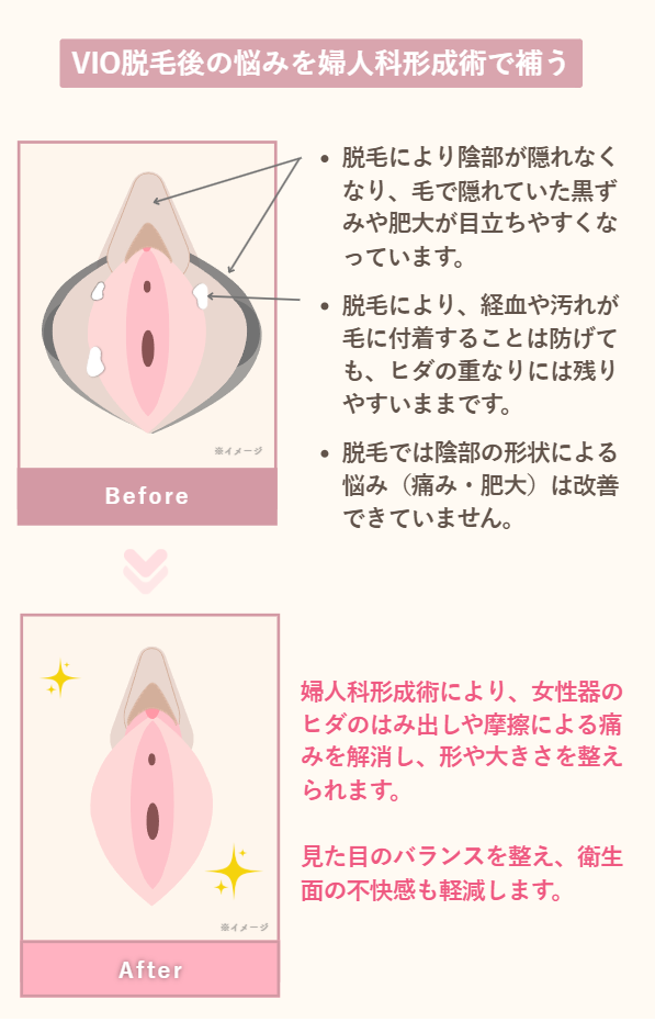 VIO脱毛後の婦人科形成術で補う