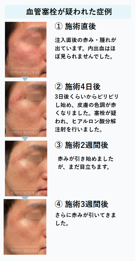【症例画像】スキンバイブ注入後の血管閉塞が疑われた