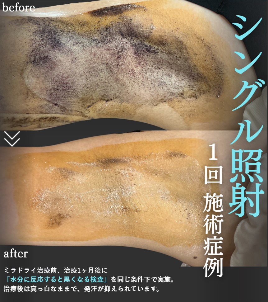 ミラドライシングル照射1回の症例画像
