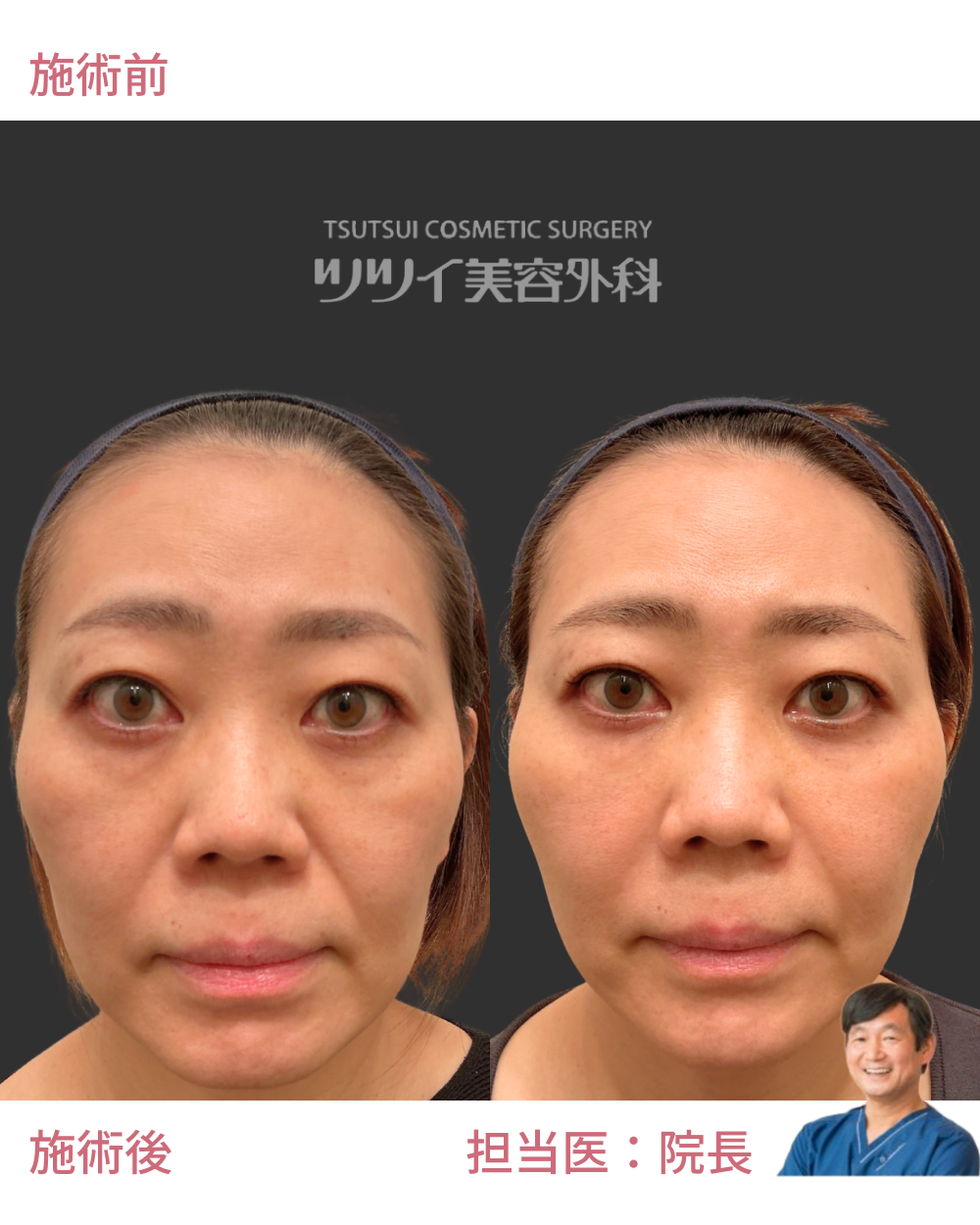 ヒアルロン酸注入 | ツツイ美容外科（大阪・心斎橋）