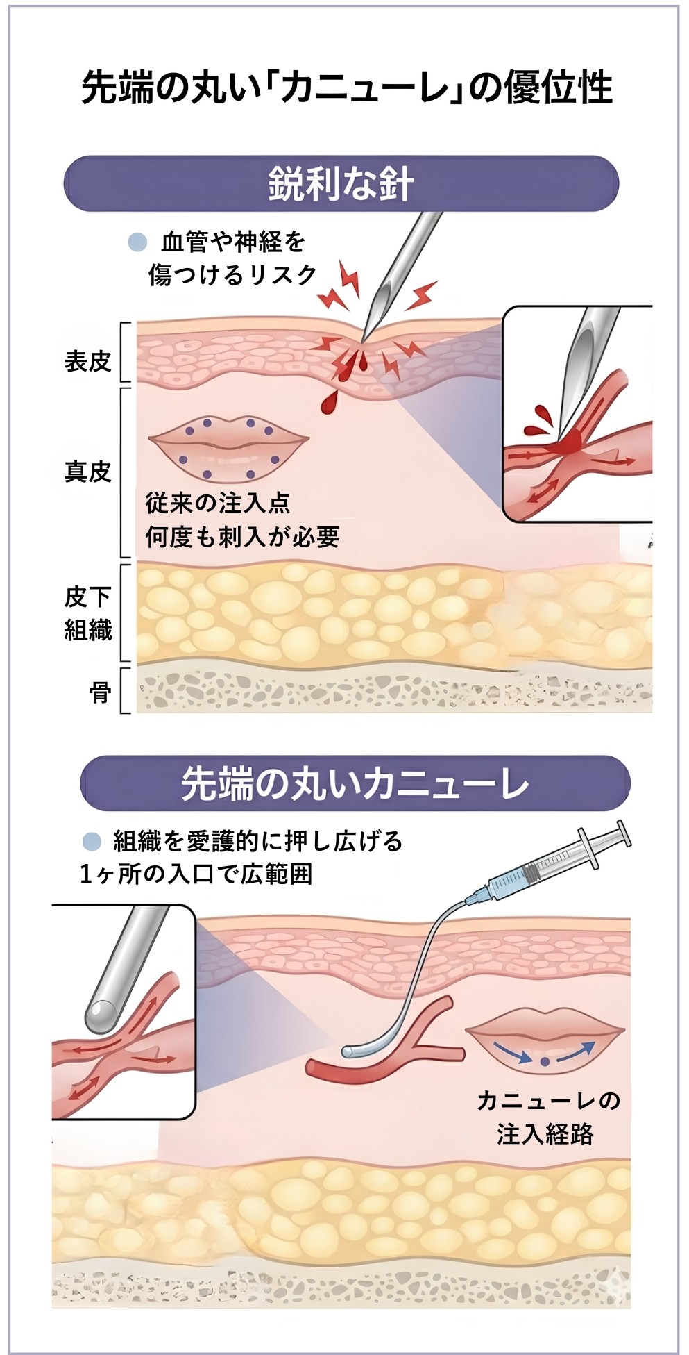 ヒアルロン酸_先端の丸い「カニューレ」の優位性