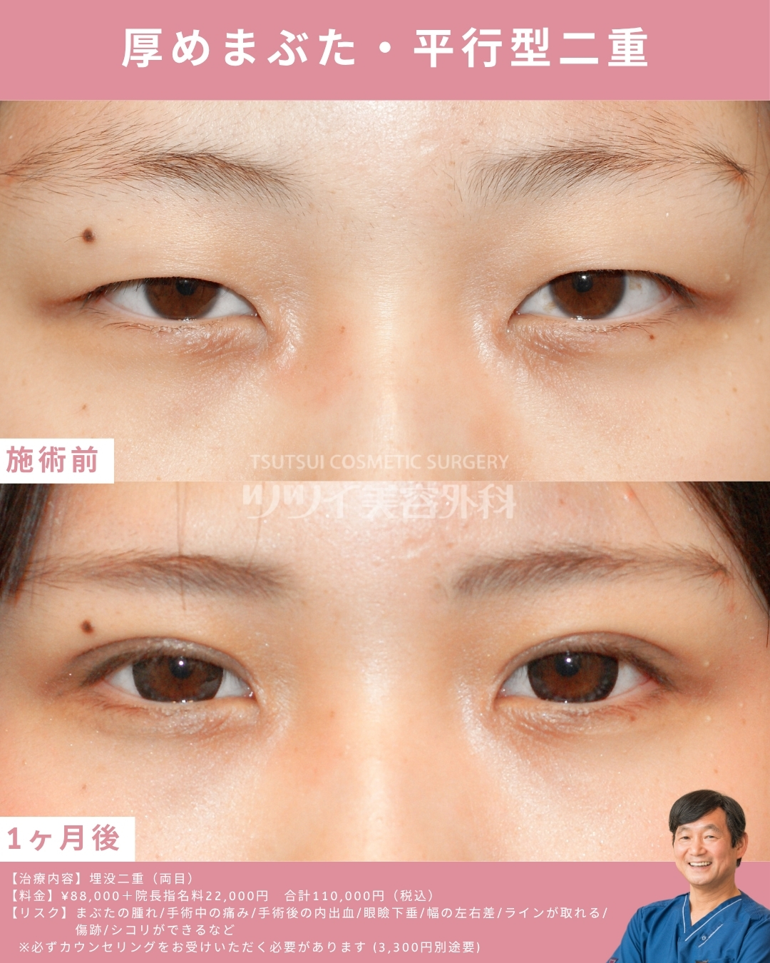 厚めまぶた平行型二重症例