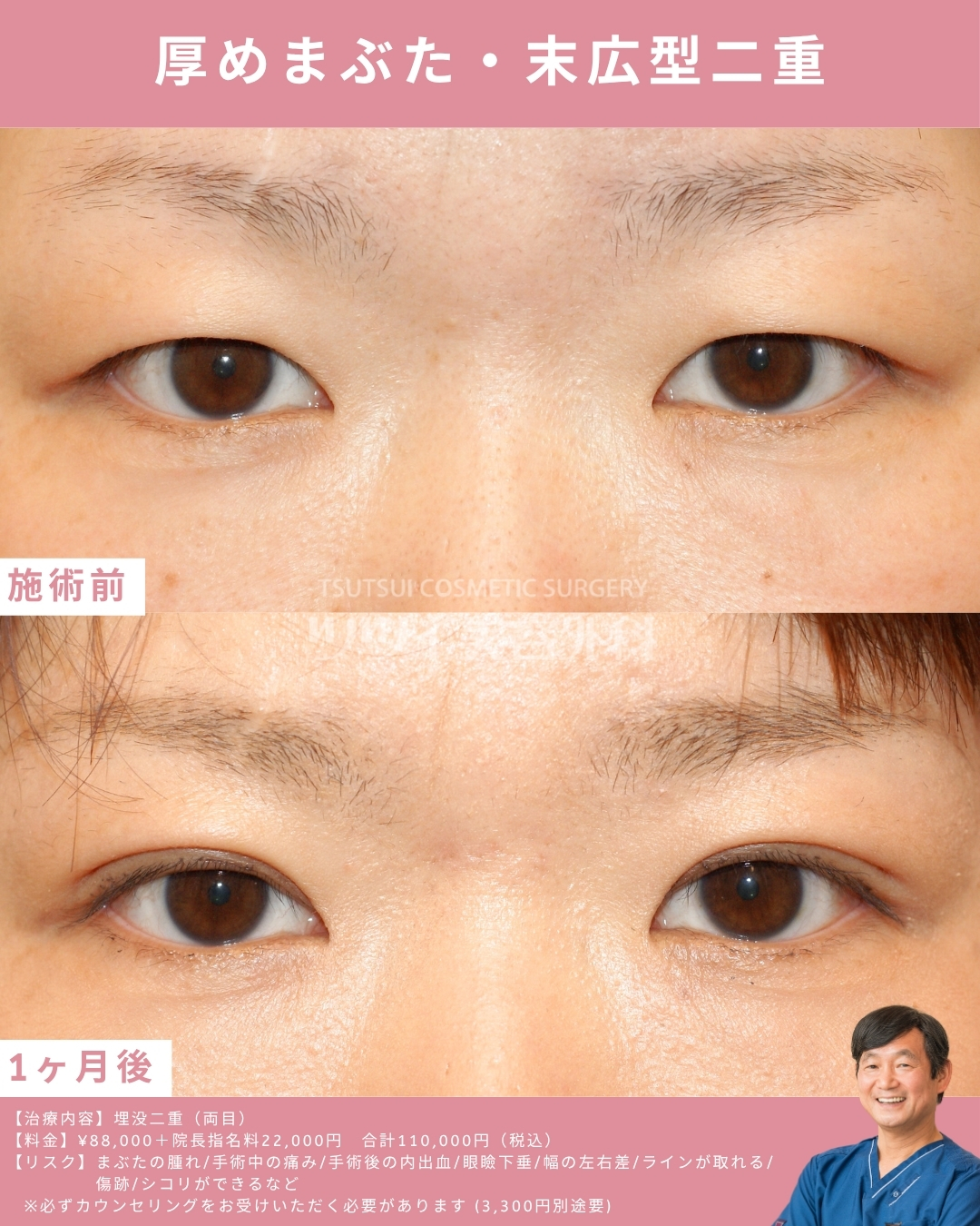 厚めまぶた末広型二重症例