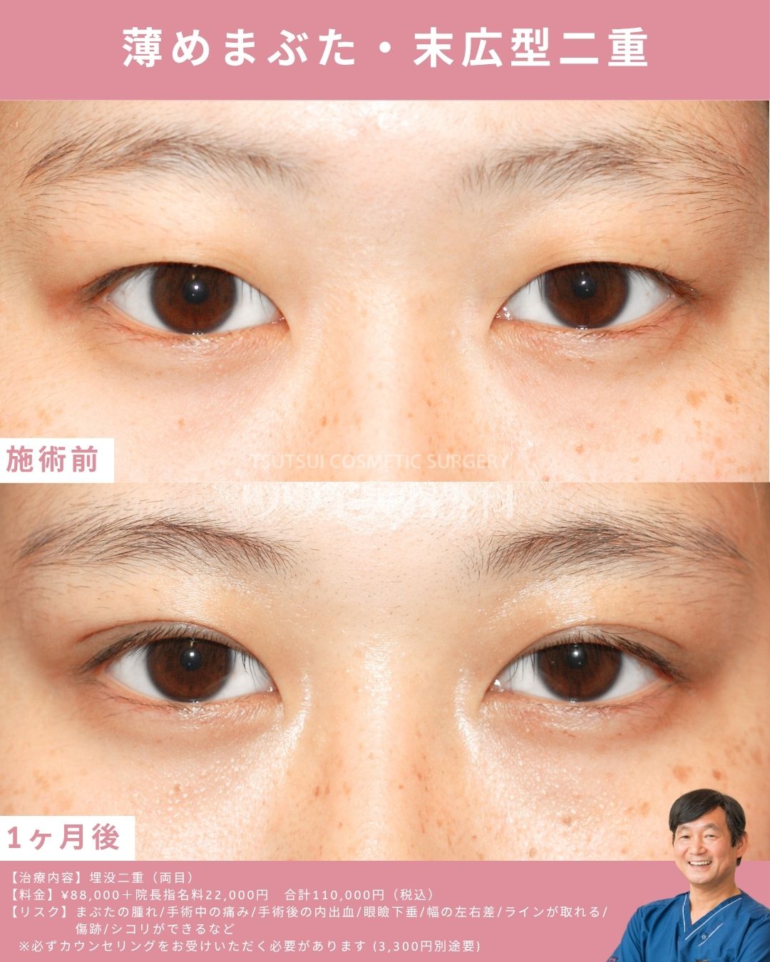 薄めまぶた末広型二重
