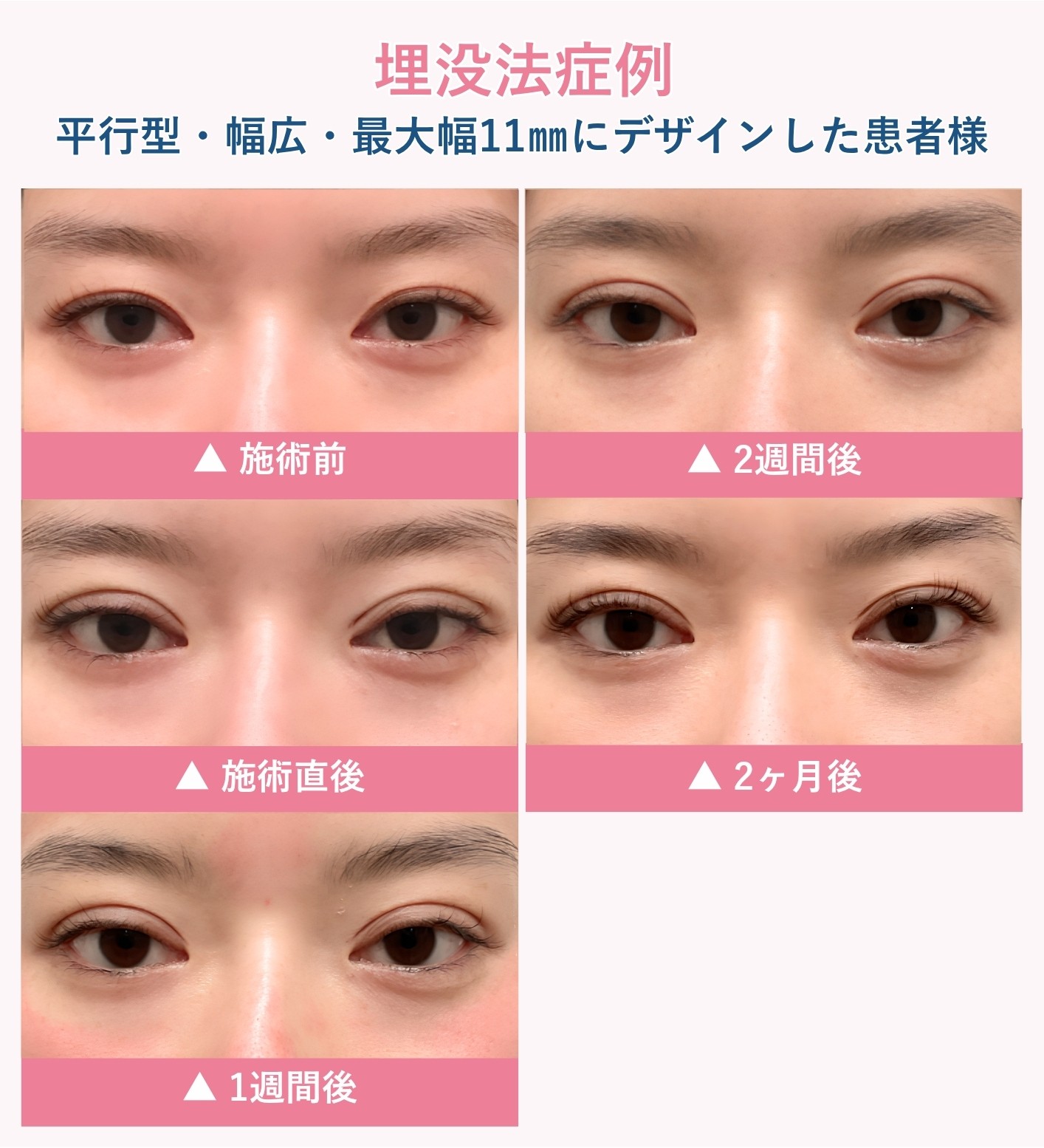 埋没法の腫れの経過症例①