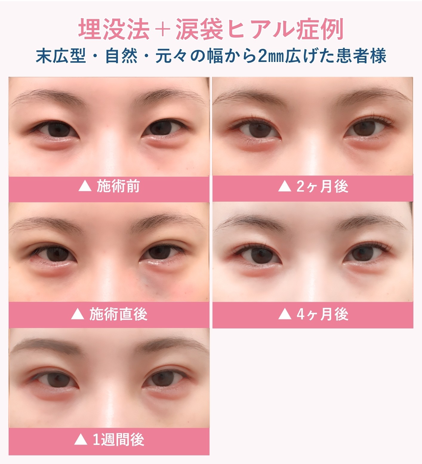 埋没法の腫れの経過症例②