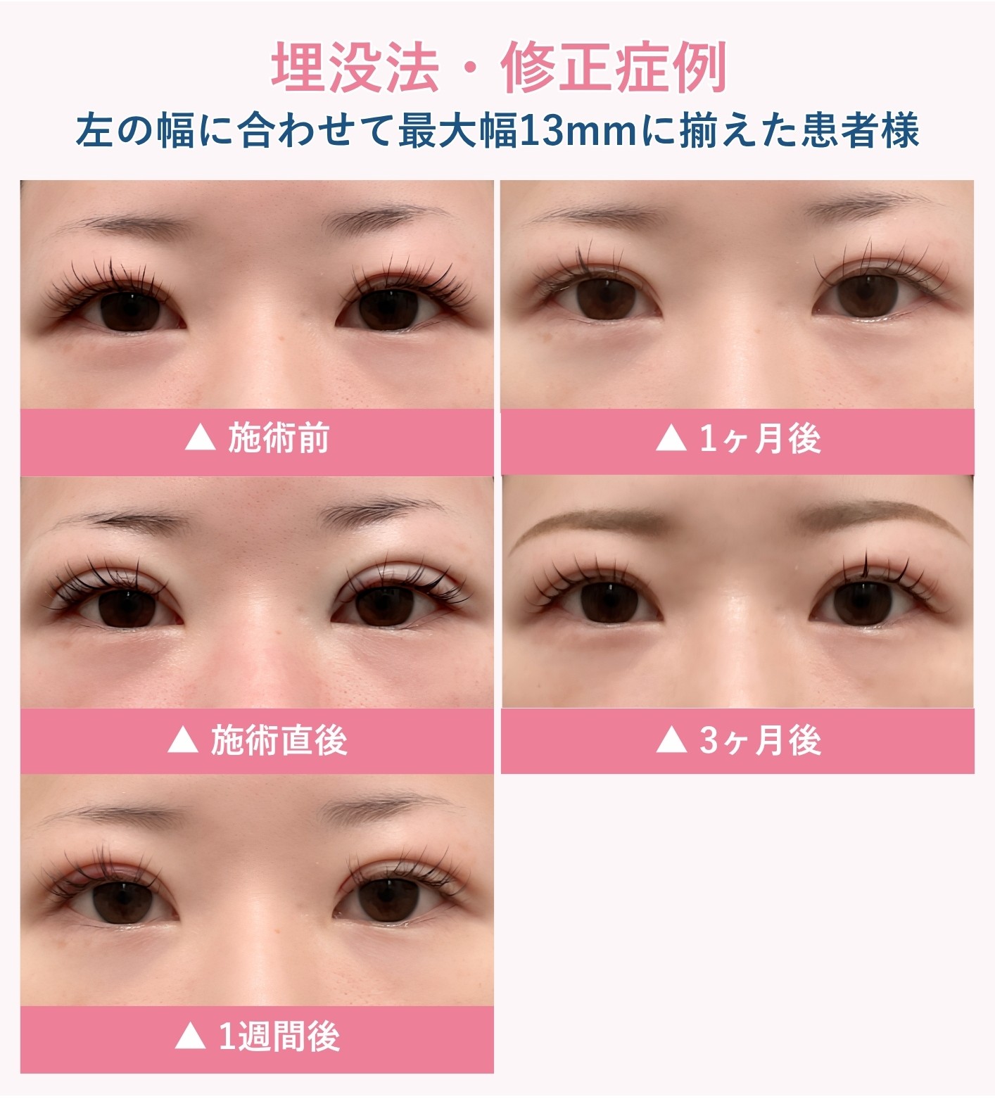 埋没法の腫れの経過症例④