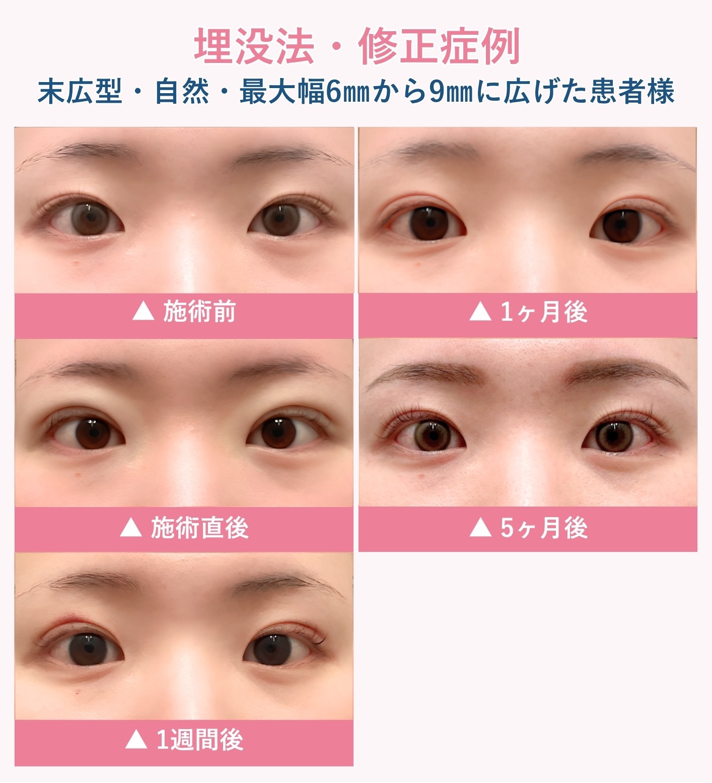 埋没法の腫れの経過症例⑤