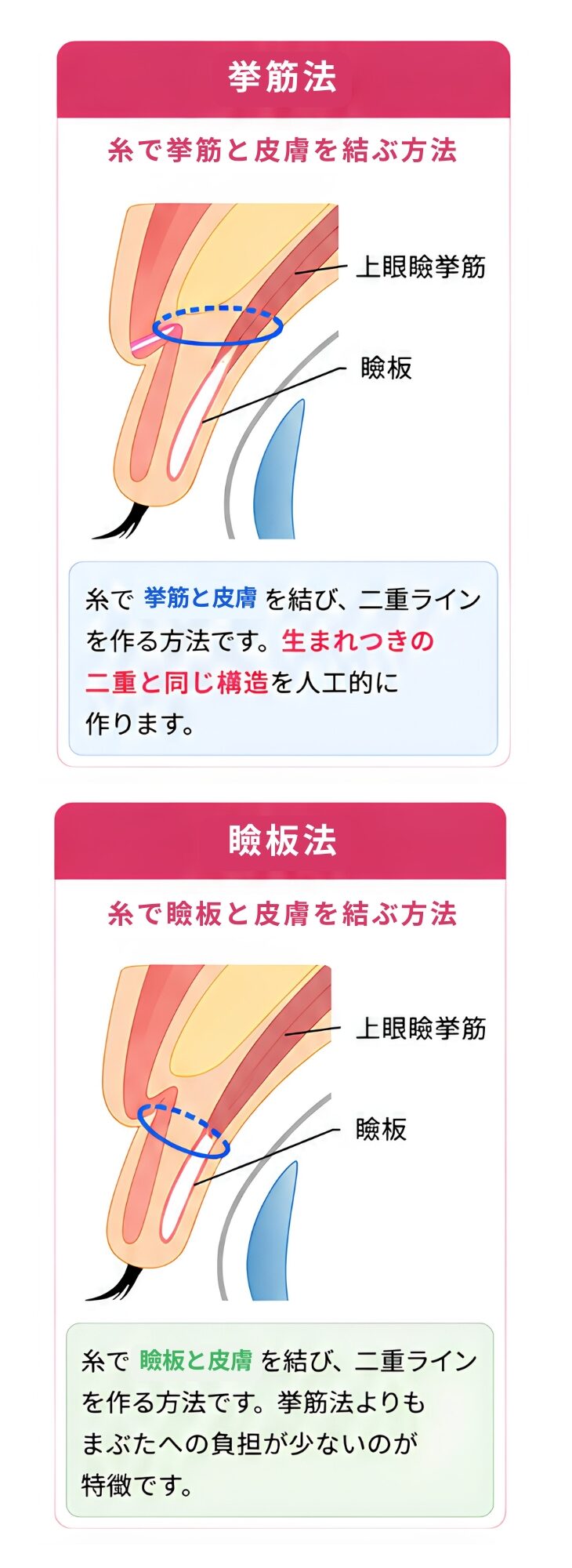 挙筋法と瞼板法の解説図